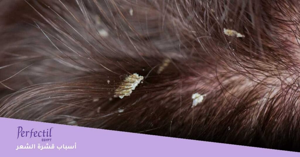 أسباب قشرة الشعر