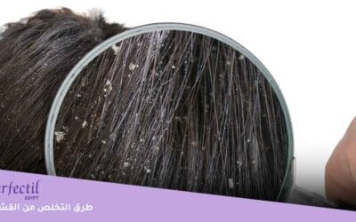 إليكِ كيفية التخلص من القشرة بمكونات بسيطة في كل منزل