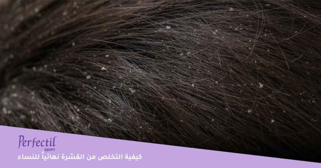 كيفية التخلص من القشرة نهائياً للنساء