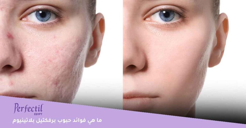 ما هي فوائد حبوب برفكتيل بلاتينيوم