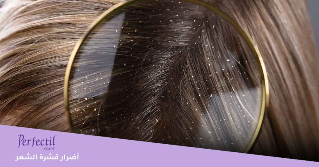 ما هي أضرار قشرة الشعر ؟