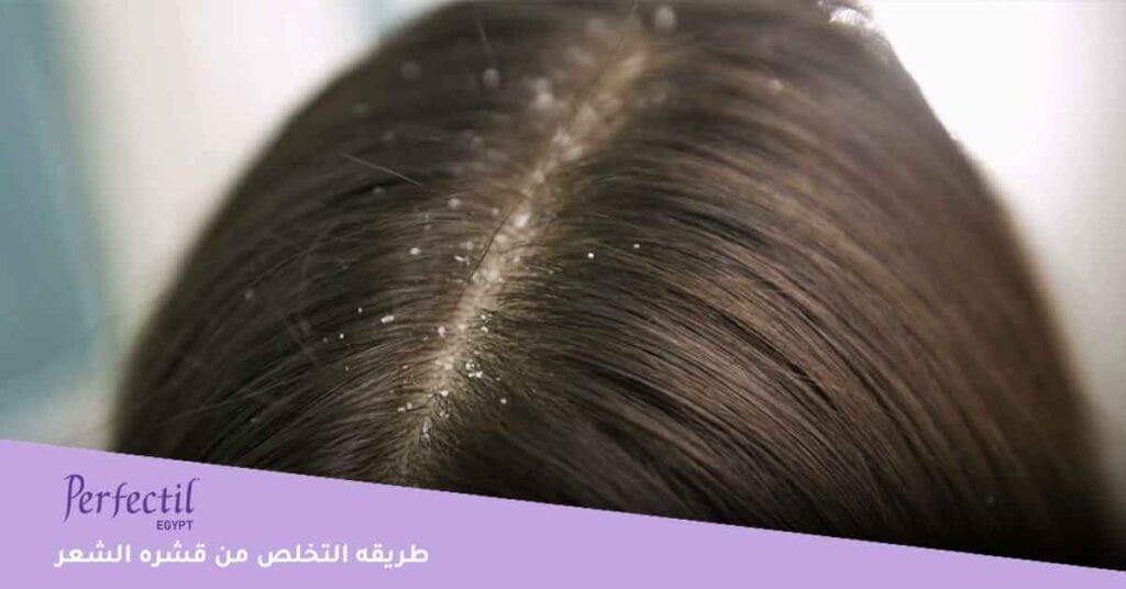 ما هي طريقه التخلص من قشره الشعر طبيعًا؟