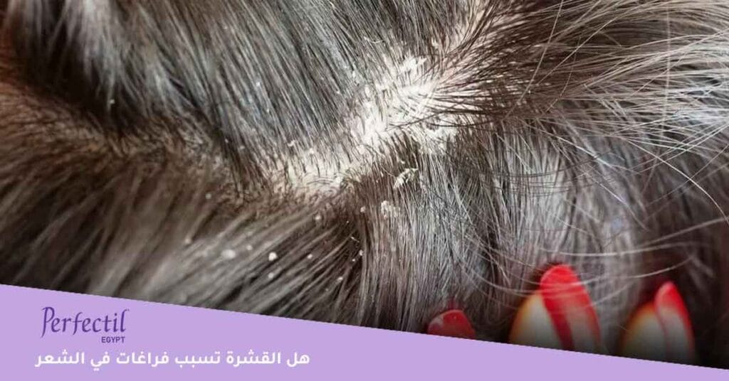 هل القشرة تسبب فراغات في الشعر؟