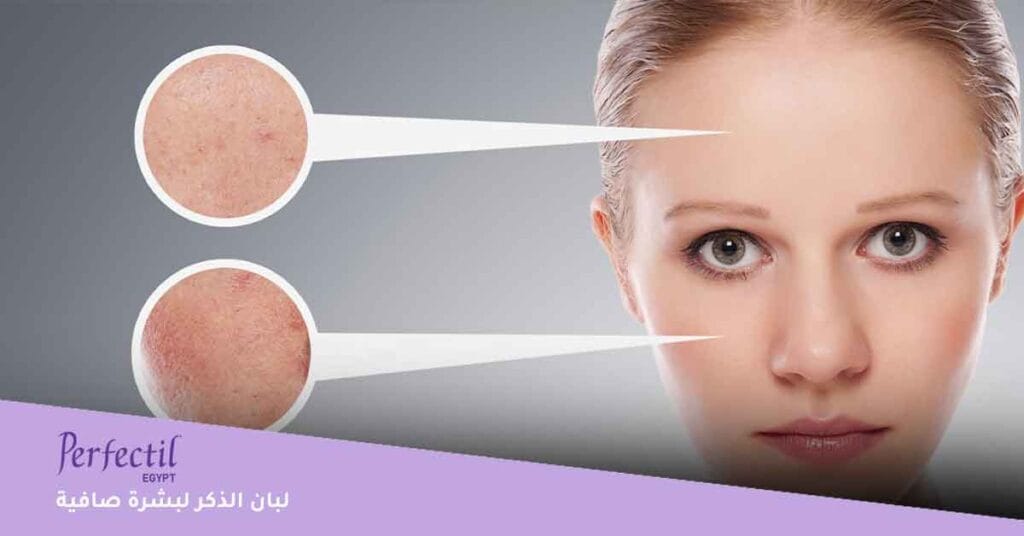 لبان الذكر لبشرة صافية