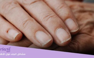 مشاكل الجلد حول الأظافر: لماذا تظهر فجأة؟ وكيف تتخلصين منها نهائيًا؟