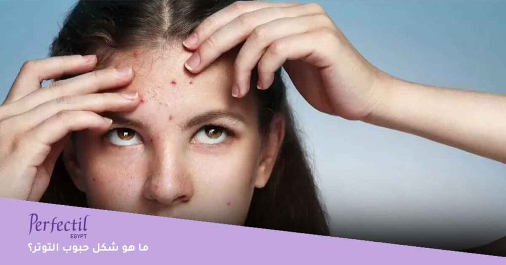 ما هو شكل حبوب التوتر؟ 