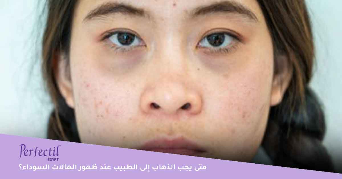 متى يجب الذهاب إلى الطبيب عند ظهور الهالات السوداء؟