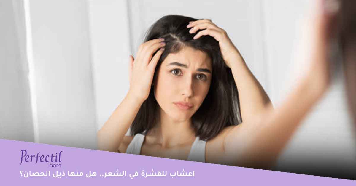 اعشاب للقشرة في الشعر