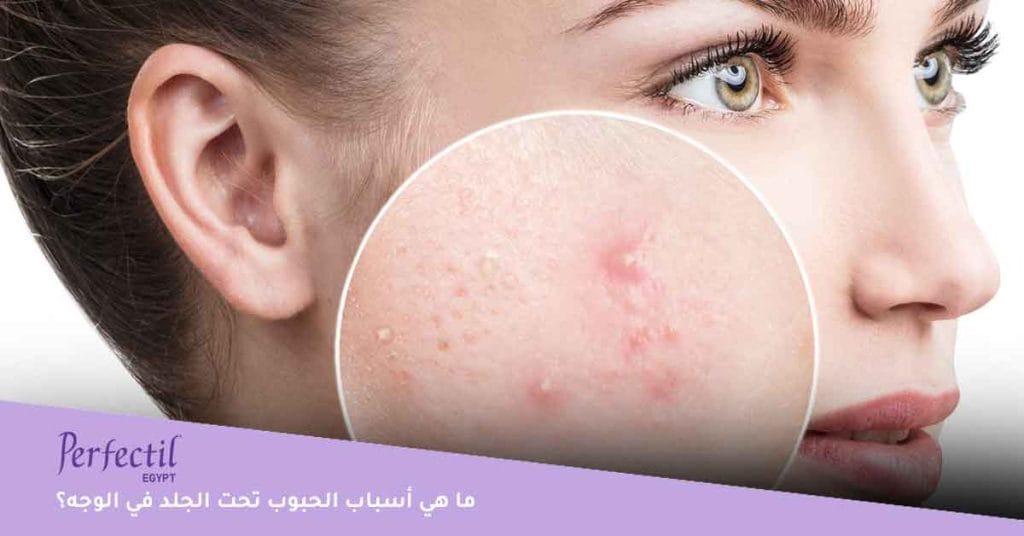 ما هي أسباب الحبوب تحت الجلد في الوجه؟