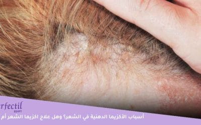 ما أسباب الأكزيما الدهنية في الشعر؟ وهل علاج اكزيما الشعر أم لا؟