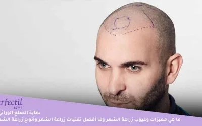 نهاية الصلع الوراثي | ما هي مميزات وعيوب زراعة الشعر وما أفضل تقنيات زراعة الشعر وأنواع زراعة الشعر؟