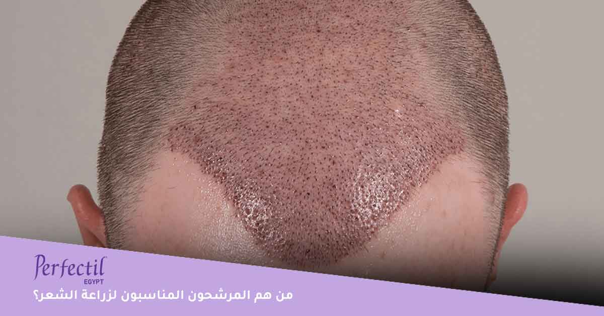 من هم المرشحون المناسبون لزراعة الشعر؟ 